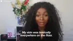 Shalom Nchom, Gadis Wajah Terbakar yang Tampil Cantik dengan Keajaiban Makeup