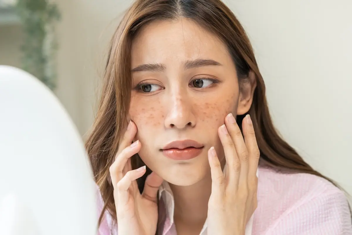 Melasma skin