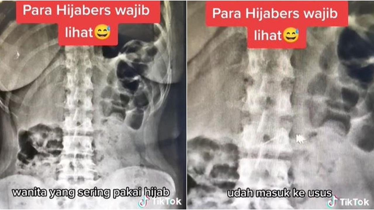 Tertancap di Usus, Wanita Ini Tak Sengaja Telan Jarum Pentul saat Pakai Hijab
