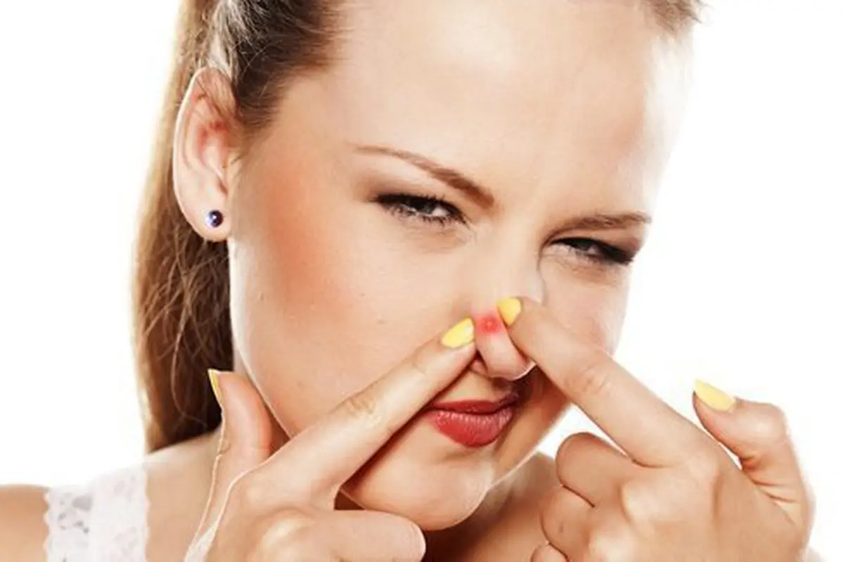 Jerawat selalu bikin kesal/copyright: thinkstockphotos.com
