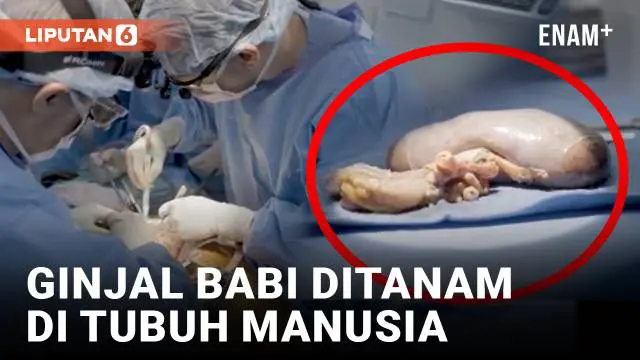 Tak ada yang menyangka jiga organ ginjal babi ternyata bisa ditranplantasi ke tubuh manusia dan berfungsi selama dua bulan. Eksperimen dramatis telah dilakukan tim dokter di Amerika Serikat yang munculkan harapan ginjal babi bisa digunakan di masa de...