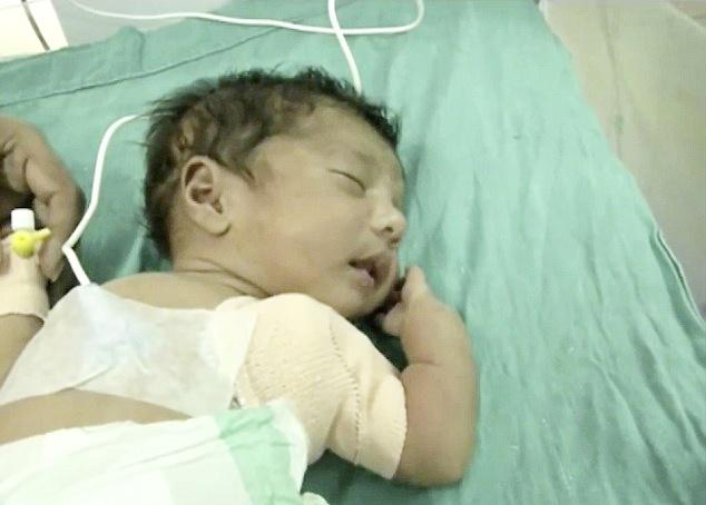 Tangan bayi setelah di operasi | foto: copyright dailymail.co.uk