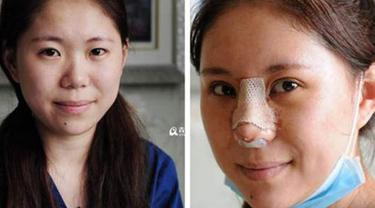 Ingin Selalu Cantik Tapi Jenuh Dengan Makeup Wanita Ini Lakukan Operasi Plastik Beauty Fimela Com