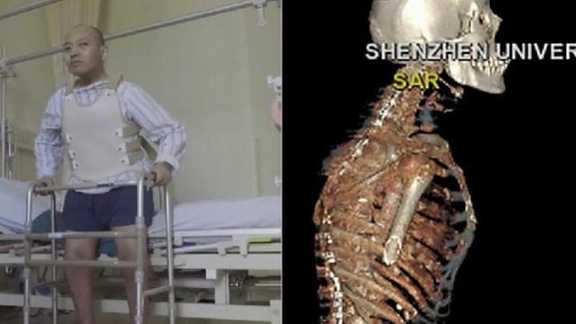 28 Tahun Hidup Membungkuk, Pria Ini Akhirnya Bisa Berdiri Tegak Kembali