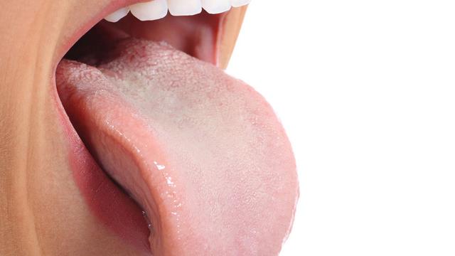 Pengertian-Penyebab-Gejala-Pengobatan-Penyakit-Kanker-Lidah