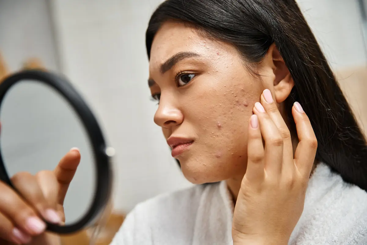 Treatment di Klinik Kecantikan Seperti Apa Sih yang Bisa Singkirkan Bekas Jerawat? Ini Jawabannya!