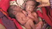 Kembar siam dengan dua kepala, empat lengan, dua kaki, dan satu kelamin lahir dengan selamat di India.