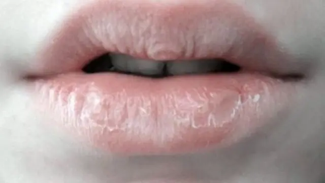 Bibir kering