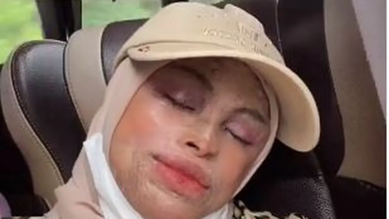 Kisah Putri Lilin dari Pariaman, Kulit Tak Boleh Terpapar Sinar Matahari Langsung