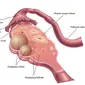 Tanda Kista Ovarium Dilihat dari Vagina