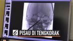 Dokter di Amerika Serikat berhasil mengeluarkan sebuah pisau yang menancap di tengkorak seorang anak.
