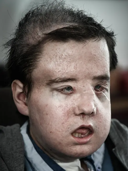 Jerome Hamon berpose di Hopital Europeen Georges-Pompidou di Paris (13/4). Transplantasi kedua dijalani, setelah upayanya gagal karena meminum obat flu yang tidak sesuai dengan pengobatan. (AFP Photo/Philippe Lopez)