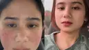 Tissa Biani mengunggah video singkat acne journeynya tepat si Hari Perempuan Internasional. Tissa mengenakan jaket abu-abu saat memerlihatkan wajahnya sudah bebas jerawat. [@tissabiani]