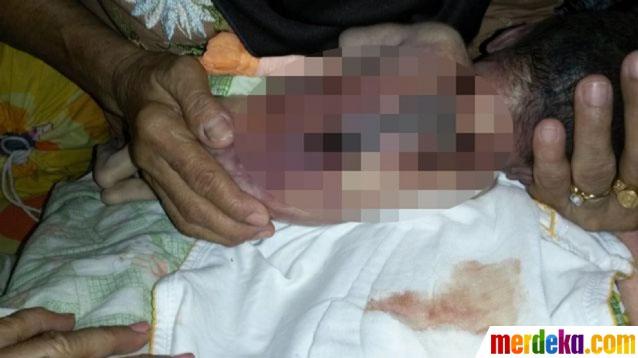 Kondisi punggung bayi Fadhlan yang terbakar | Foto: copyright merdeka.com