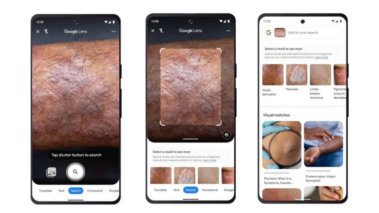 Google Lens Mendeteksi Masalah Kesehatan Kulit. Dok: Google