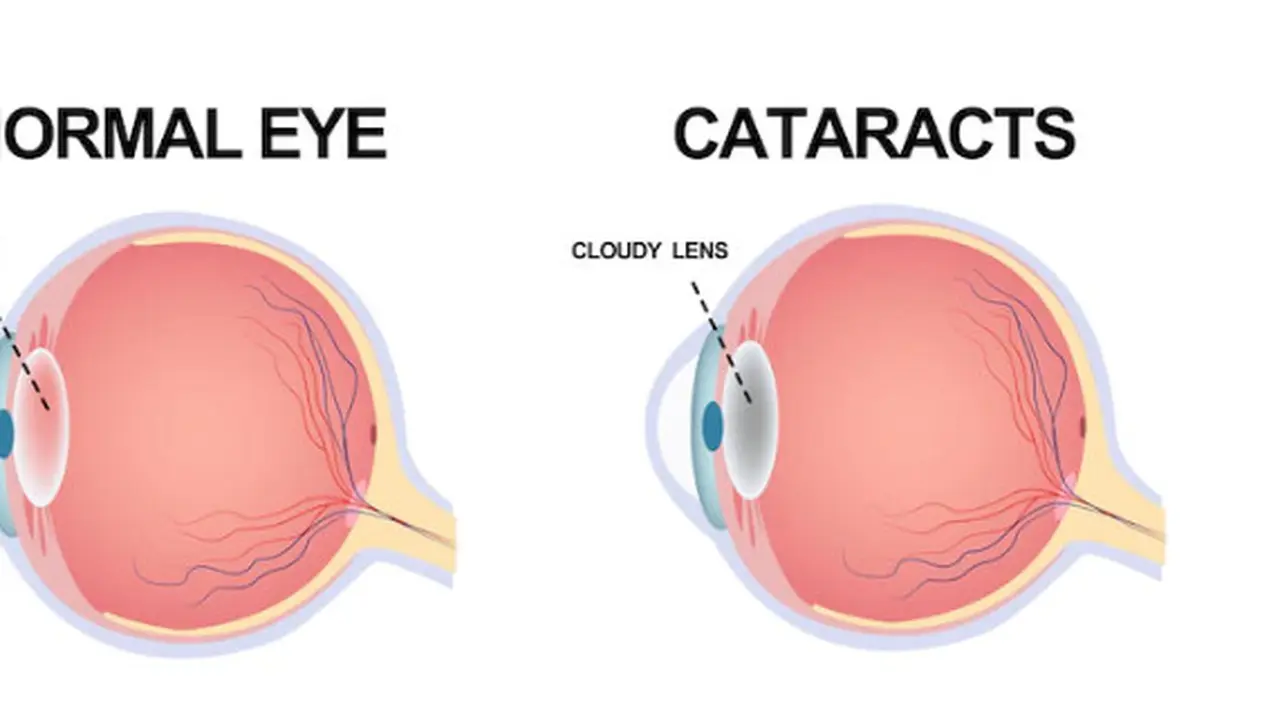 Orang Tua Jangan Gampang Percaya, Ini 6 Mitos Katarak pada Anak-Anak ...