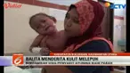 Seorang anak di Kalimantan Utara derita penyakit kulit yang aneh. 