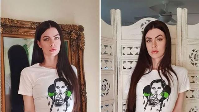 Cerita Remaja Kehilangan Kaki Akibat Kanker yang Sukses Jadi Model