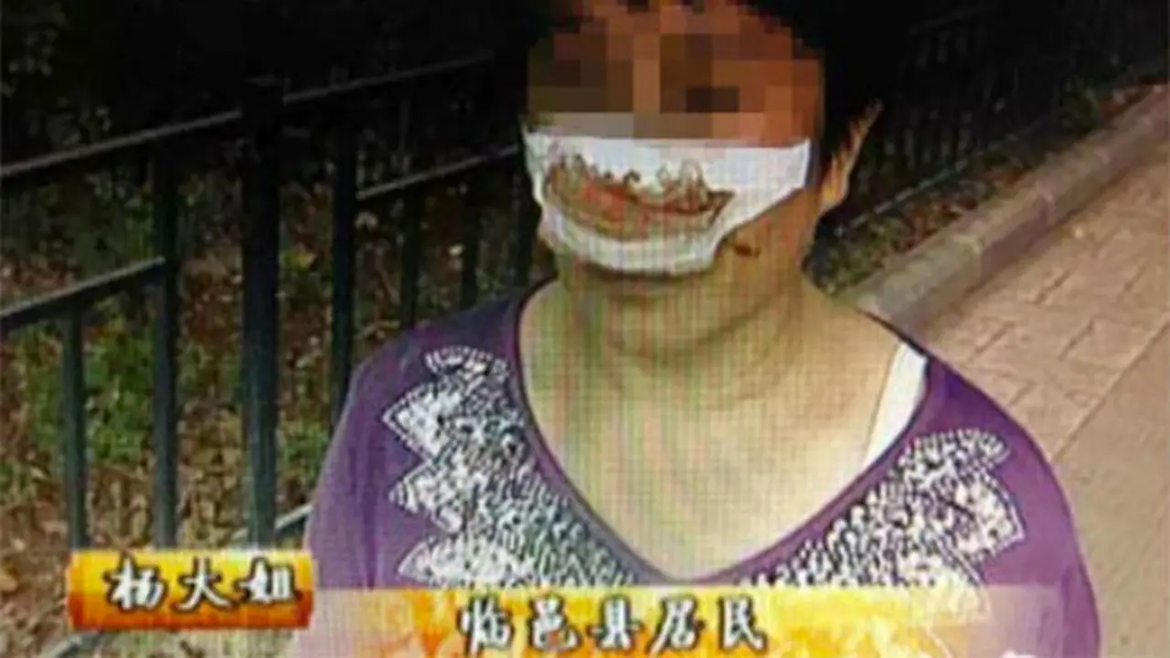 Tak Angkat Telepon Suami, Hidung Istri Digigit Hingga Putus