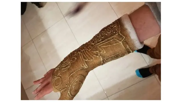Pergelangan Tangannya Cedera, Pria Ini Gunakan Hiasan Gips yang Unik