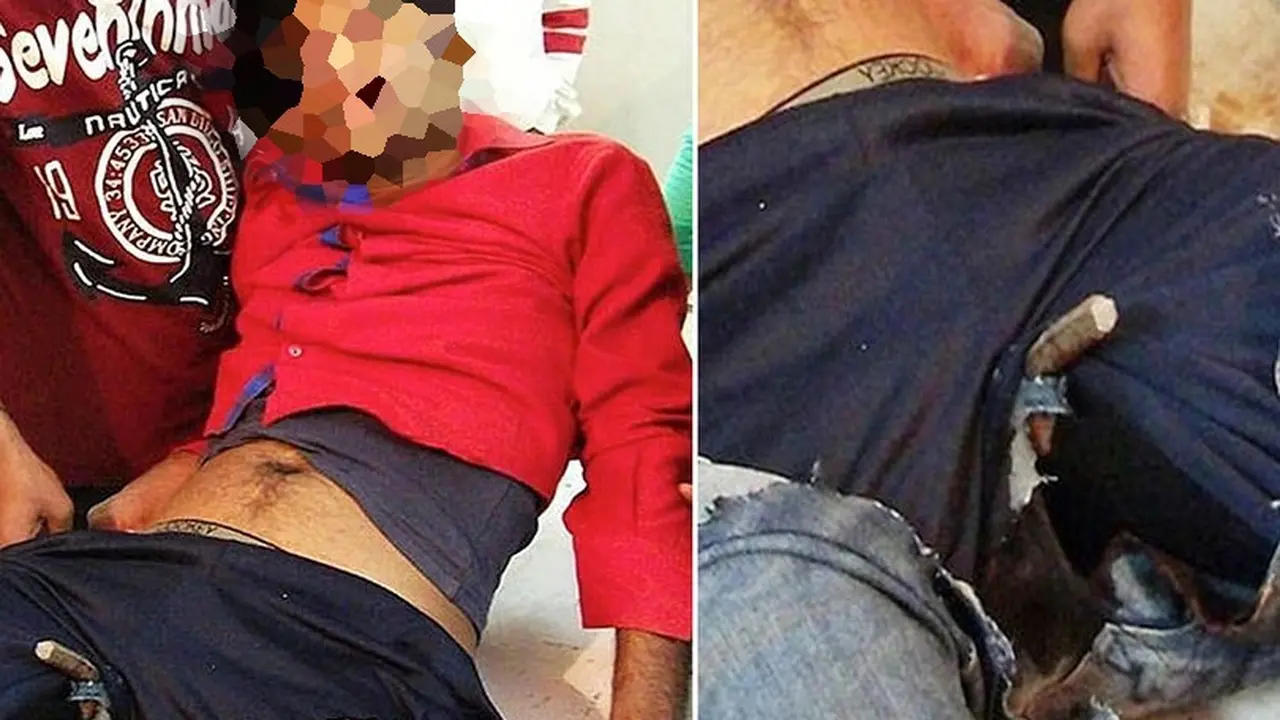 Terpeleset, Pria Malang Anusnya Tertancap Batangan Besi
