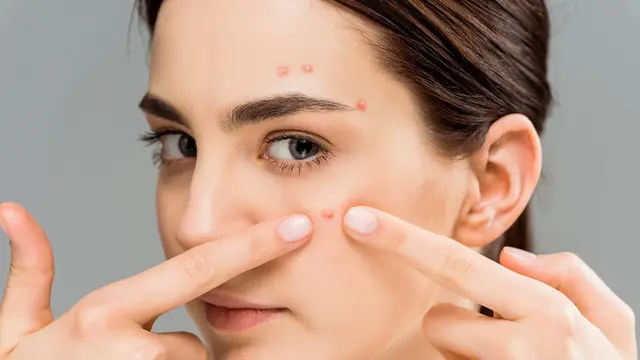 Ciri-ciri Jerawat Breakout yang Wajib Diketahui, Bagaimana Langkah Tepat untuk Mengatasinya?