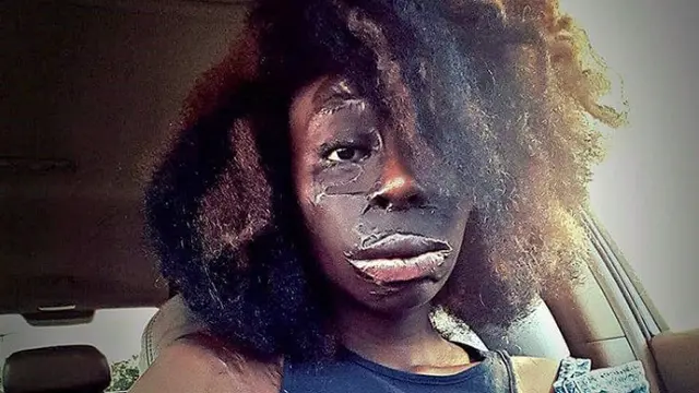 Tolak Oplas, Gadis Ini Klaim Luka di Wajahnya Bikin Makin Cantik