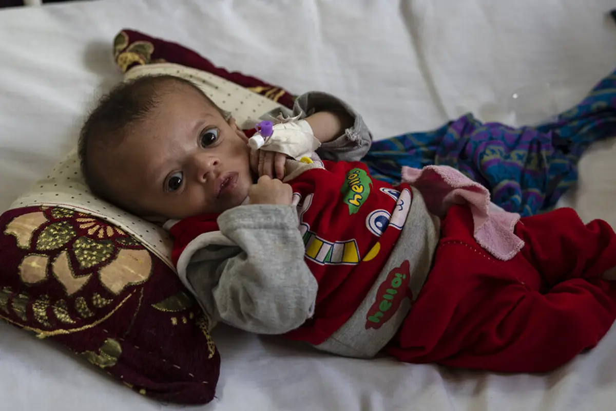 FOTO: Gizi Buruk Meningkat, Anak-Anak Afghanistan Penuhi Bangsal Rumah Sakit