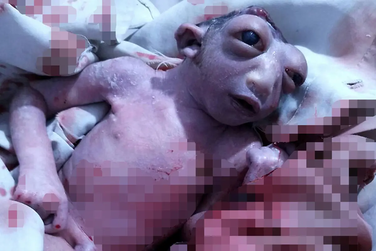 Lahir dengan Setengah Kepala, Bayi Mungil Ini Berjuang Hidup