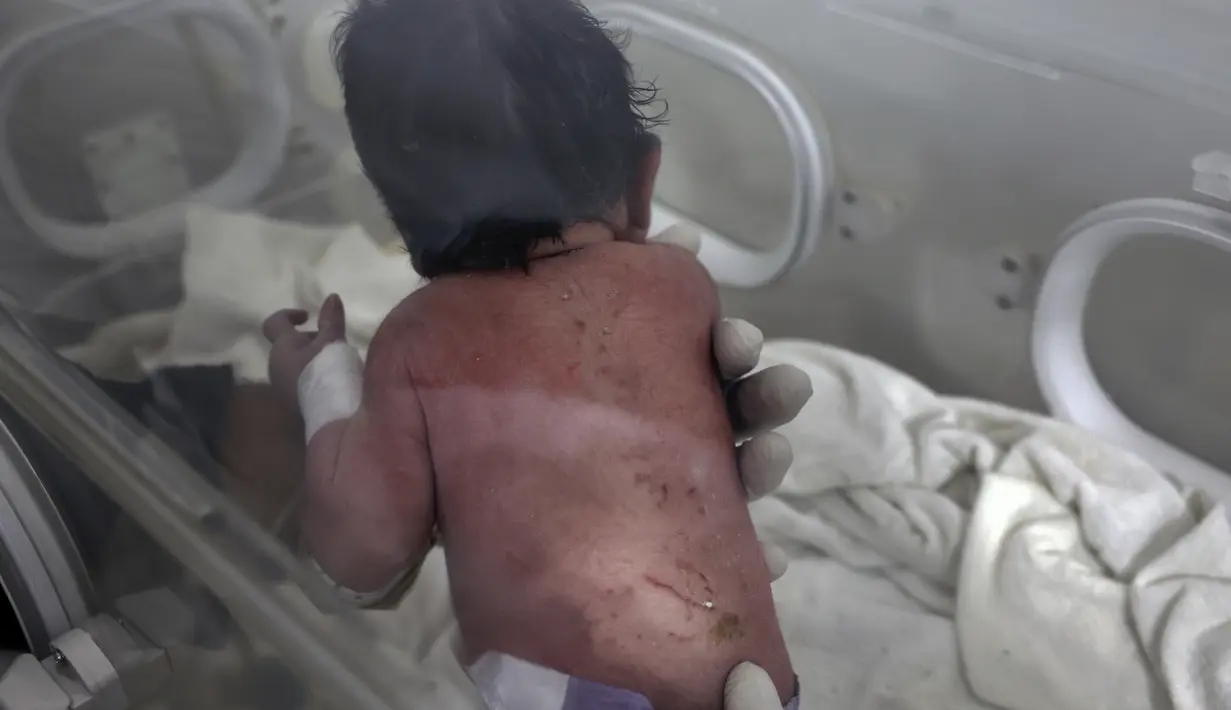 Seorang bayi perempuan yang lahir di bawah reruntuhan akibat gempa bumi yang melanda Suriah dan Turki menerima perawatan di dalam inkubator di rumah sakit anak di kota Afrin, provinsi Aleppo, Suriah, Selasa (7/2/2023). Video penyelamatan bayi itu viral di media sosial. Rekaman menunjukkan seorang pria berlari dari puing-puing bangunan empat lantai yang runtuh sambil menggendong bayi mungil yang tertutup debu. (AP Photo/Ghaith Alsayed)