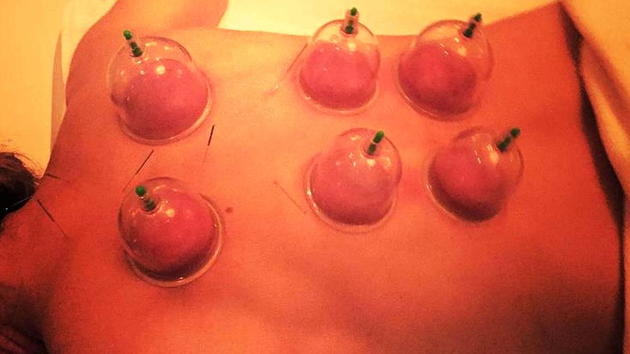 Madonna Pamer Terapi Bekam Untuk Atasi Stres