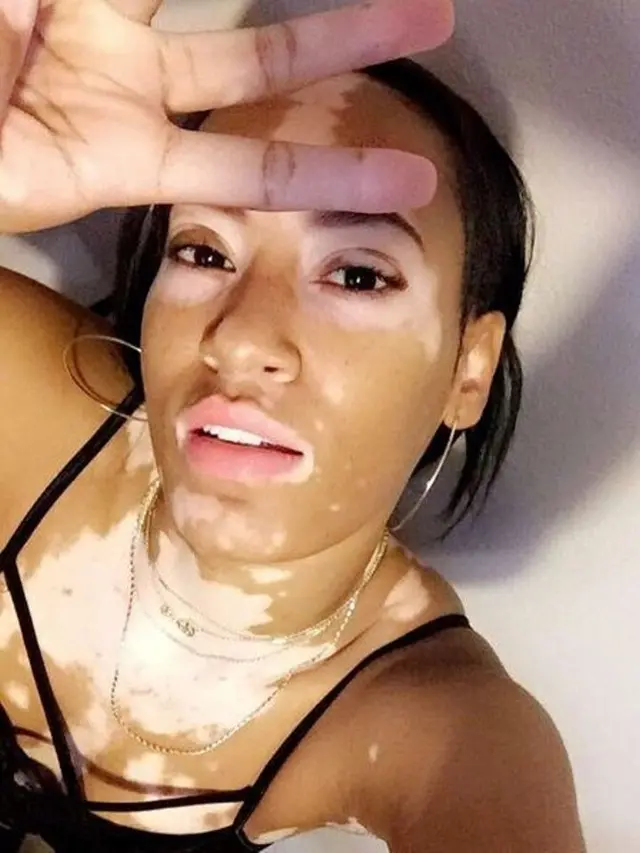 [Bintang] Menderita Vitiligo, Amy Deanna Berhasil Jadi Model yang Mendunia