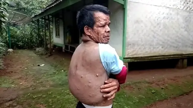 Teten, Pria dengan Kutil di Sekujur Tubuh