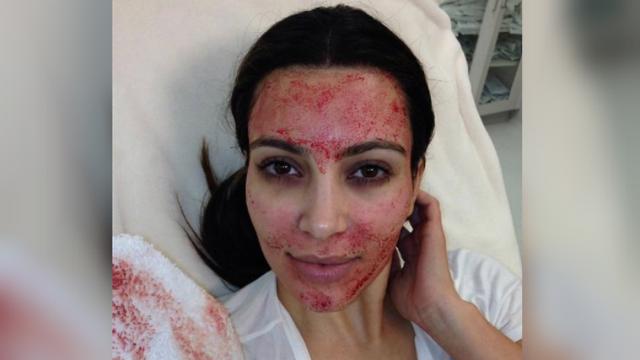 Kim Kardashian sedang melakukan facial darah (Kim Kardashian).