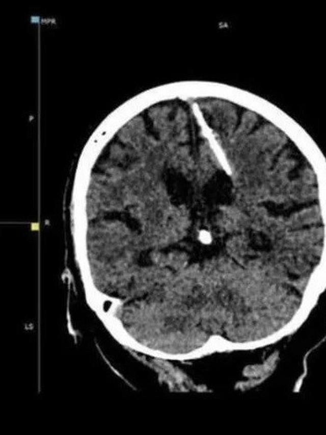 Jarum Tertancap di Otak