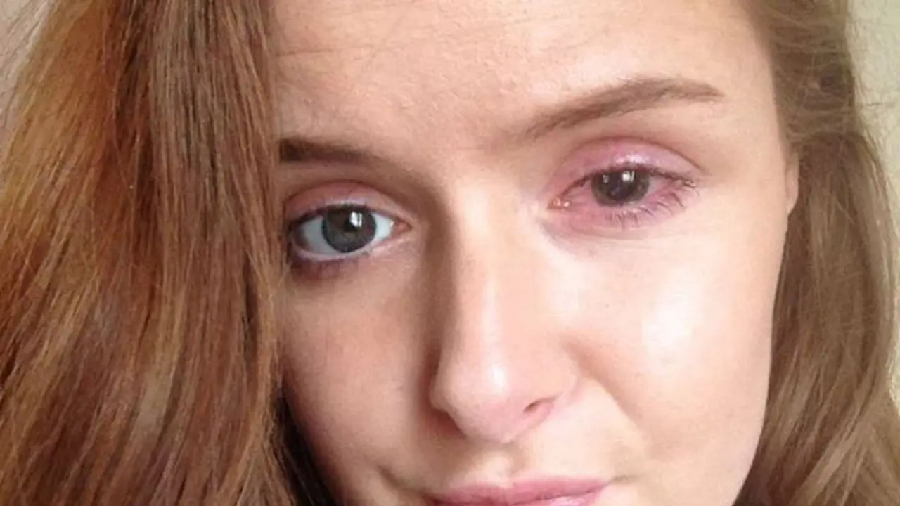 lensa kontak
