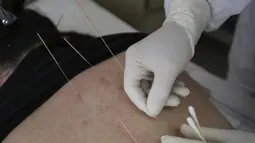 Akupuntur Berujung Petaka, 10 Jarum Tertinggal di Kaki Wanita