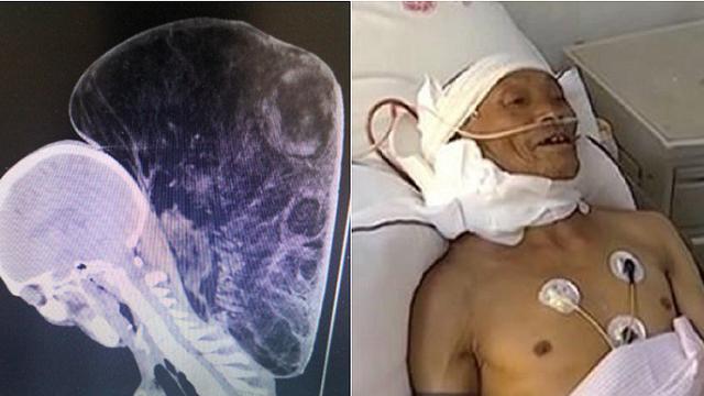 Dibiarkan Selama 47 Tahun, Pria Ini Punya Tumor Di Leher Seberat 15 Kg