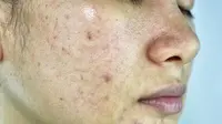 4 Perawatan Wajah Terkini untuk Singkirkan Bekas Jerawat Jahat, Semua Ada di ERHA ULTIMATE