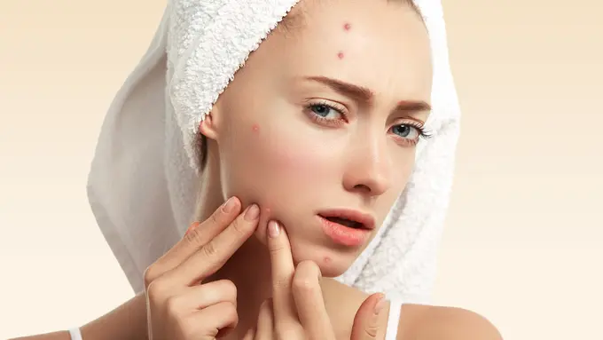 Jerawat yang Muncul Hilang Tiba-Tiba Bikin Kesal? Kenali Penyebab dan Cara Mengatasinya - Cover