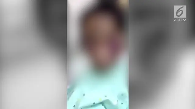 Seorang anak perempuan usia 5 tahun alami muka penuh lebam. Diduga ia dianiaya oleh orangtua tirinya.