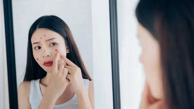 Kenali 7 Penyebab Jerawat Sering Muncul dan Susah Hilang Beserta Solusinya