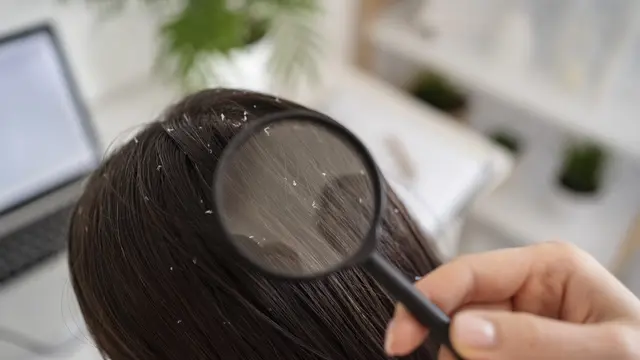 Ilustrasi ketombe/freepik.com/EyeEm