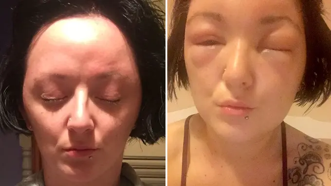 Sangat Mengganggu Hari-harimu, Kenapa Kamu Bisa Alergi?