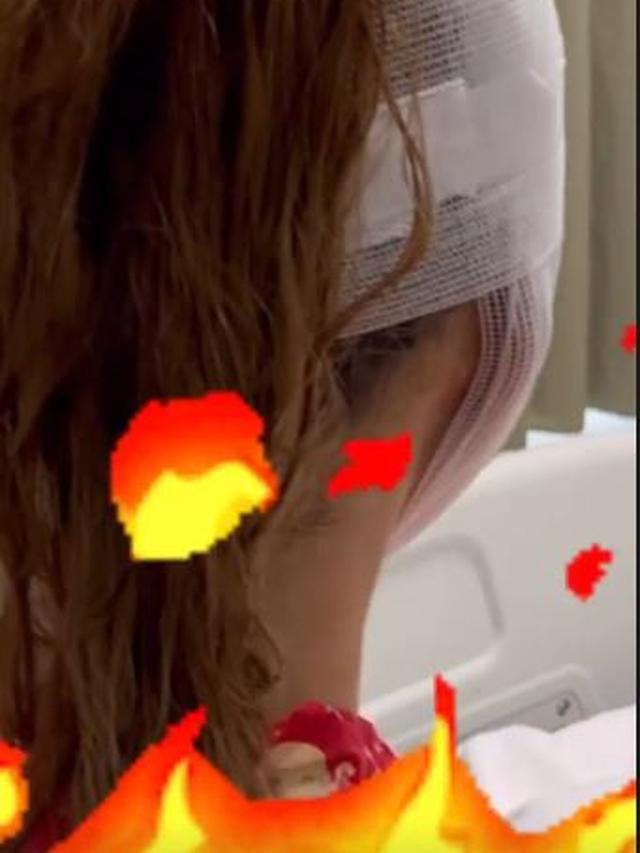 Lucinta Luna Diduga Lakukan Operasi Plastik, Ini 6 Potretnya dengan Wajah Diperban