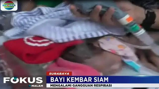 Bayi Kembar Siam asal Ternate Siap Jalani Pemisahan di RSUD dr Soetomo
