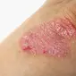 Psoriasis merupakan penyakit kronis tidak menular yang menyerang kulit, menyebabkan bercak kemerahan dan sisik putih berlapis (Foto:Medscape)