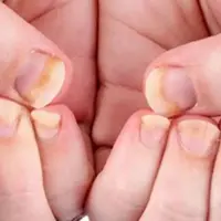 Kuku berjamur. (Sumber: Freepik.com)