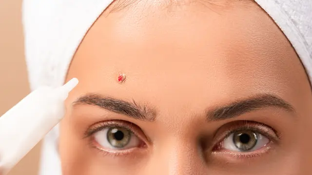 Manfaat Obat Totol Jerawat: Benarkah Ampuh untuk Atasi Jerawat Secara Instan?