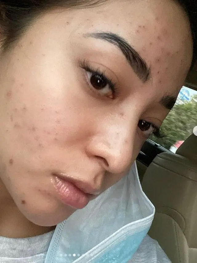 Potret 6 Seleb Unggah Foto Bare Face Lagi Berjerawat, Cintai Diri Sendiri Apa Adanya